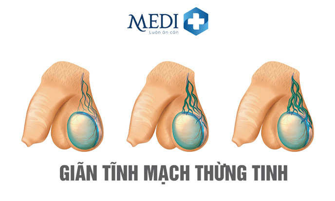 Giãn tĩnh mạch thừng tinh