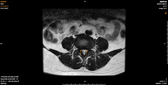 Hình ảnh chụp Cắt lớp vi tính (CT) bị thoát vị đĩa đệm cột sống thắt lưng