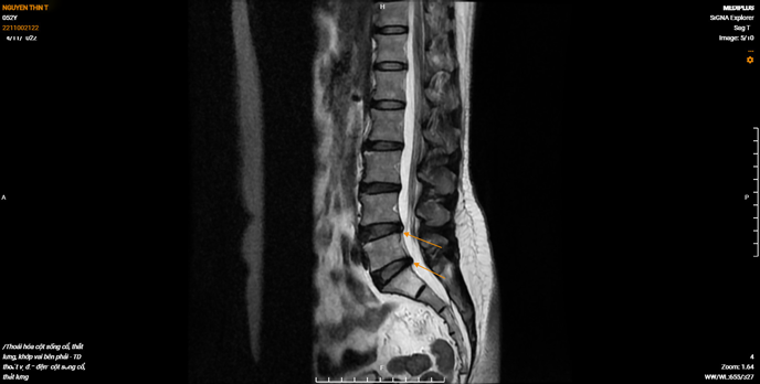 Chụp CT chẩn đoán vị trí thoát vị đĩa đệm cột sống thắt lưng