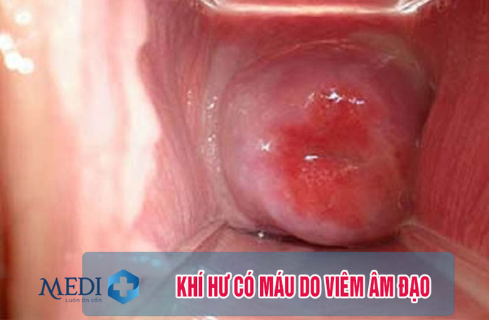 Ra khí hư có máu do bị viêm âm đạo thường là do nấm hoặc ký sinh trùng