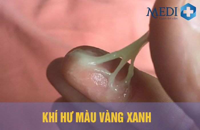 Khí hư màu vàng xanh ra nhiều