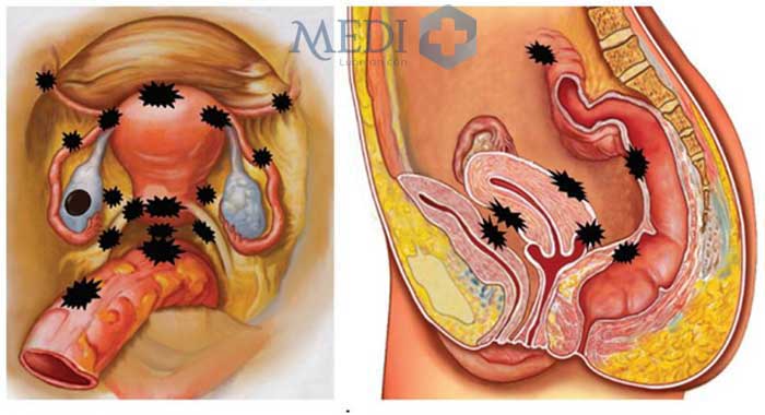 Niêm mạc tử cung bị lạc chỗ trong tiểu khung bên ngoài buồng tử cung.