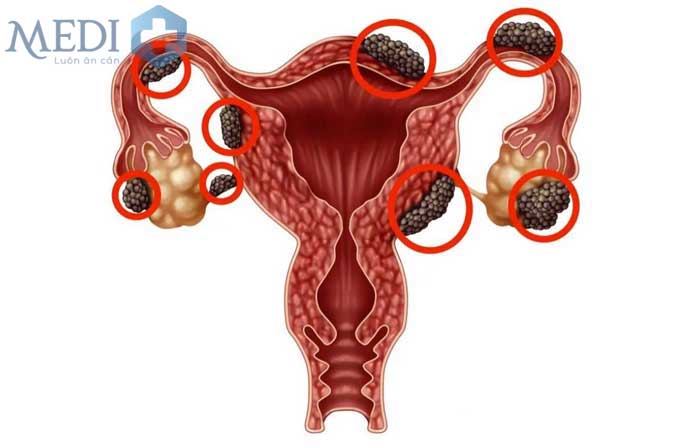 Lạc nội mạc tử cung siêu âm có thấy rõ tình trạng bệnh?