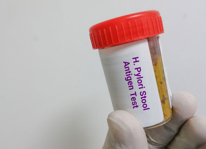 Test HP trong phân tìm vi khuẩn