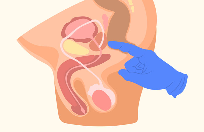 Nguyên nhân phì đại tiền liệt tuyến do nhiều yếu tố, chế độ sinh hoạt hoặc mắc các bệnh lý khác