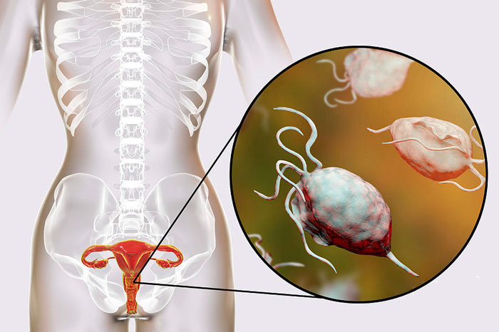 Nhiễm trùng Trichomonas