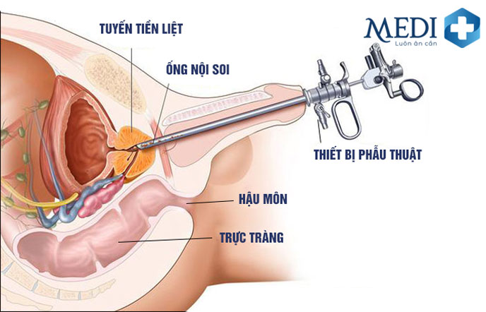 Phẫu thuật nội soi tuyến tiền liệt khi sử dụng nội khoa chưa mang lại hiệu quả