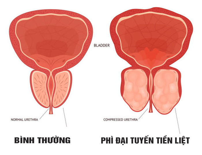 Phì đại tuyến tiền liệt