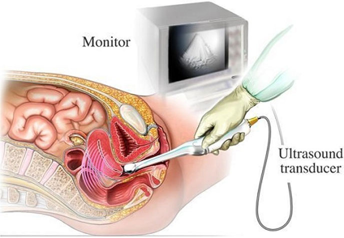 Siêu âm đàu dò giúp phát hiện sớm các vấn đề cơ quan sinh sản