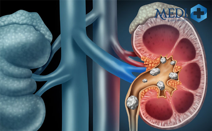 Người bị sỏi thận khiến tình trạng đi tiểu nhiều lần trong ngày