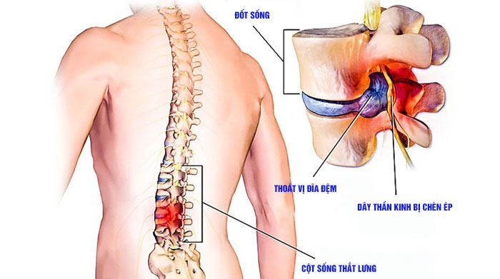 Thoát vị đĩa đệm cột sống thắt lưng đang trở nên khá phổ biến, người trẻ vẫn có nguy cơ mắc