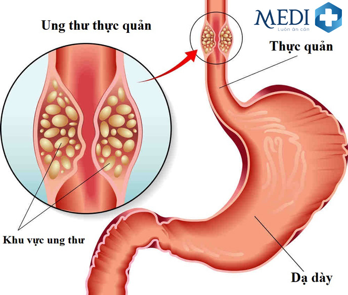 Trào ngược dạ dày tiến triển thành ung thư thực quản nếu không được điều trị sớm