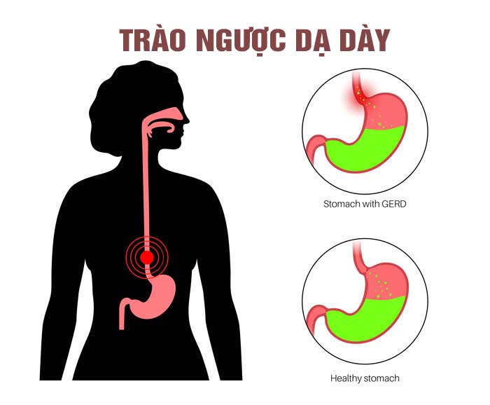 Trào ngược dạ dày