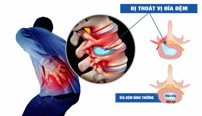 Thoát vị đĩa đệm cột sống thắt lưng: Triệu chứng nhận biết và cách điều trị hiệu quả