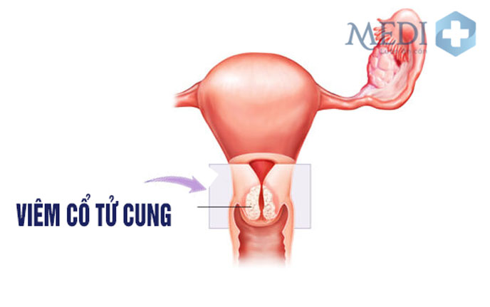 Triệu chứng bệnh lý viêm cổ tử cung