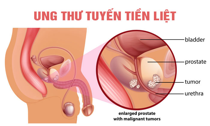 Ung thư tiền liệt tuyến