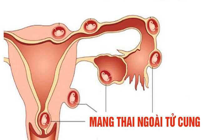 Những vị trí mang thai ngoài tử cung và cần được xử lý tránh biến chứng