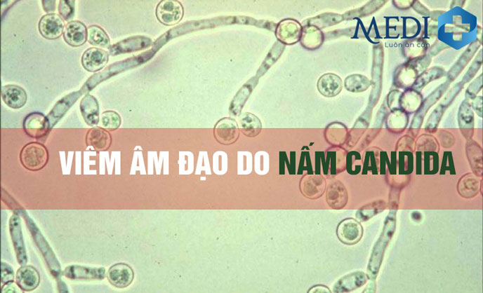 Triệu chứng viêm âm đạo do nấm candida