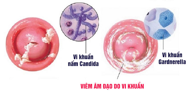 Viêm nhiễm âm đạo do vi khuẩn