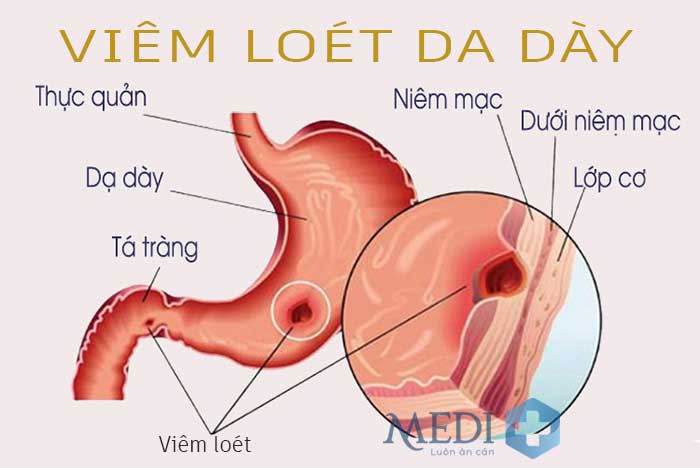 Viêm loét dạ dày tá tràng là nguyên nhân chính gây chảy máu dạ dày