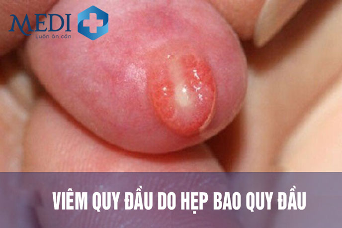 Hình ảnh hẹp bao quy đầu gây viêm quy đầu