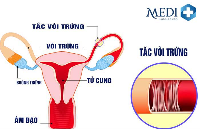 Viêm tắc vòi trứng là nguyên nhân hàng đầu gây vô sinh