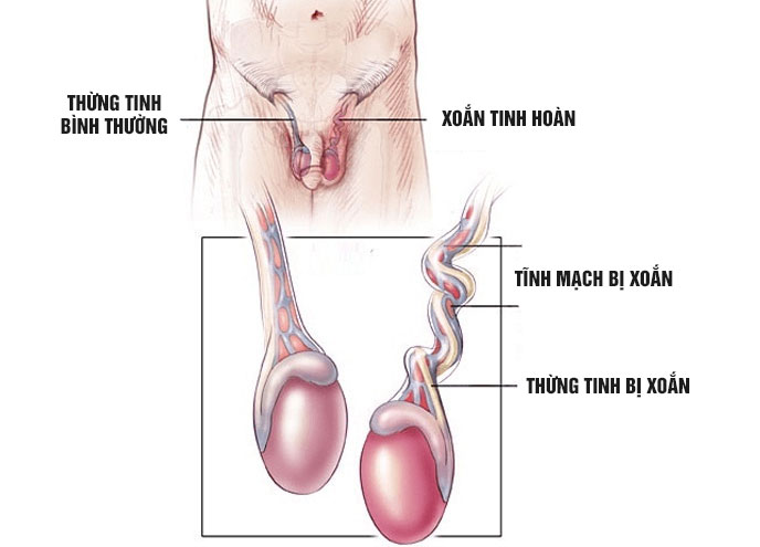 Tinh hoàn bị xoắn