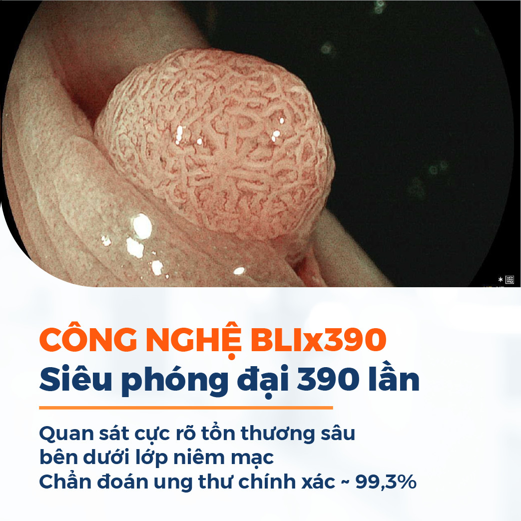 Công nghệ nội soi BLIx390 hiện đại nhất thế giới tích hợp nhiều tính năng vượt trội