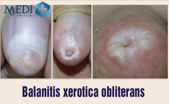 Balanitis xerotica obliterans (BXO) - Quy đầu cứng lại và chuyển sang màu trắng