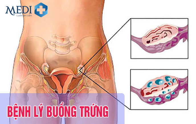 Bệnh lý ở buồng trứng gây trễ kinh thường thấy ở chị em phụ nữ