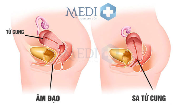 Bị sa tử cung sa thành âm đạo khiến tử cung bị tụt xuống