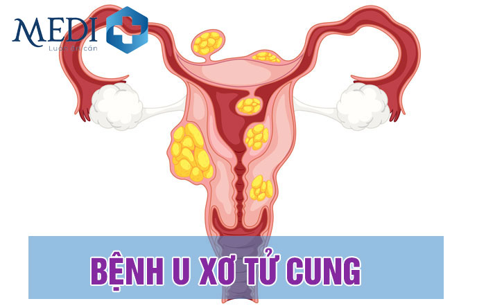 U xơ tử cung nguy cơ biến chứng thành Ung thư tử cung?