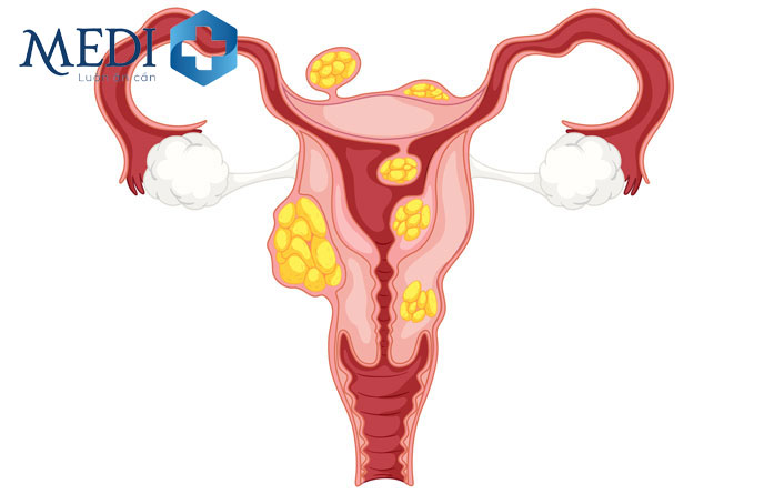 U xơ tử cung khá phổ biến hiện nay ở mọi lứa tuổi