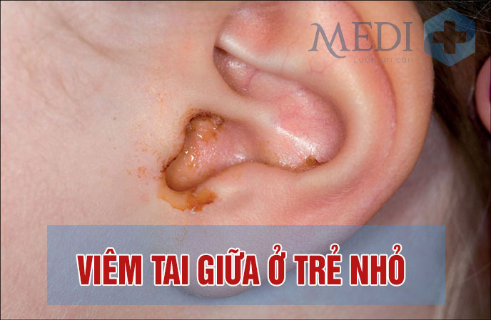 Bệnh viêm tai giữa ở trẻ em dấu hiệu cha mẹ cần biết sớm