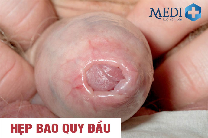 Bị hẹp bao quy đầu