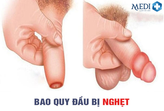 Bao quy đầu bị nghẹt