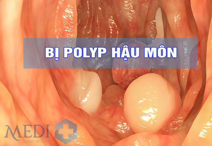 Bị polyp hậu môn nguyên nhân và cách điều trị