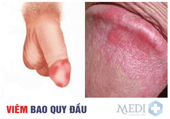 Bị viêm bao quy đầu