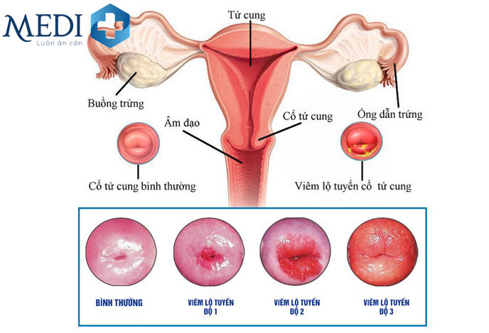 Viêm lộ tuyến cổ tử cung cấp độ 2 biểu hiện khá rõ gây đau rát và chảy máu