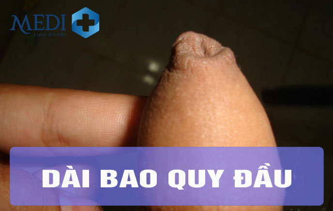 Dài bao quy đầu không xử lý sớm có thể là tác nhân gây một số bệnh nam khoa