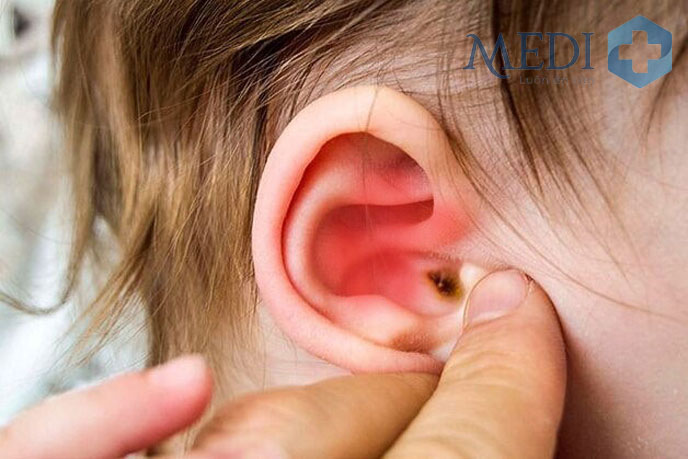 Dấu hiệu khi trẻ bị viêm tai giữa cha mẹ cần đặc biệt lưu ý