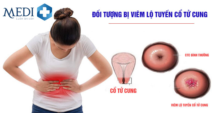 Các đối tượng dễ mắc viêm lộ tuyến cổ tử cung