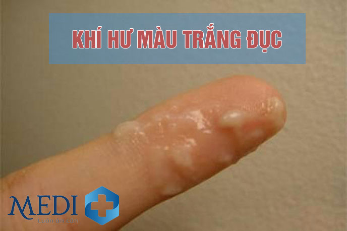 Ra khí hư màu trắng đục ở vùng kín có nguy hiểm không?