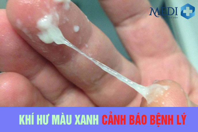 Khí hư ra nhiều có màu xanh CẢNH BÁO nhiều bệnh lý nguy hiểm