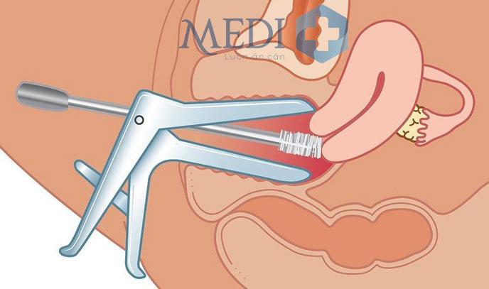 Sử dụng mỏ vịt để thăm khám và chẩn đoán khi bị sa tử cung