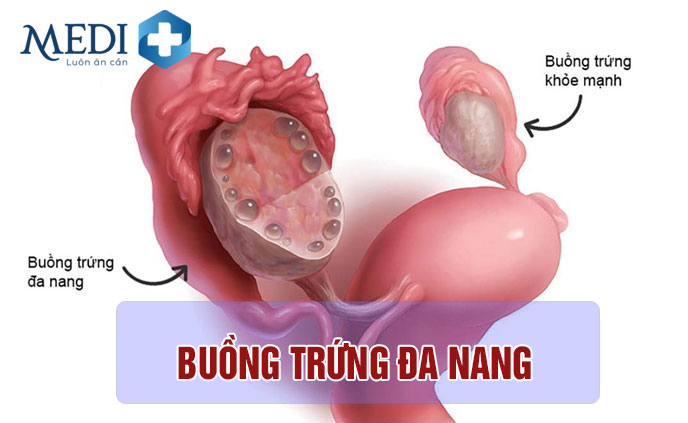 Kinh nguyệt ra ít do hội chứng buồng trứng đa nang