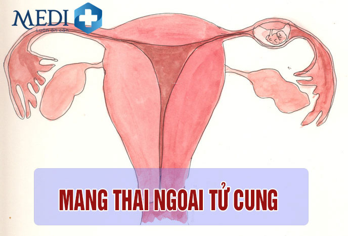 Mang thai ngoài tử cung khiến kinh nguyệt ra ít chị em cũng cần lưu ý