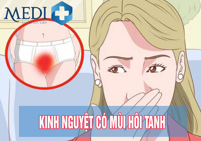 Kinh nguyệt có mùi hôi tanh – Bệnh lý phụ khoa