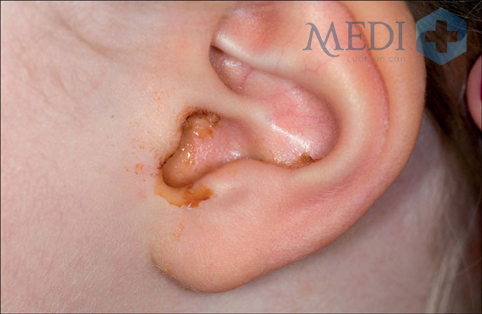 Nguyên nhân chính gây viêm tai giữa ở trẻ nhỏ