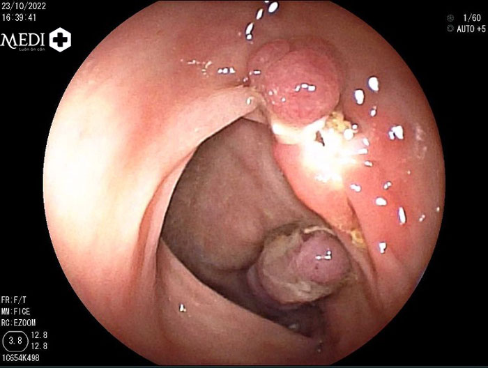 Bệnh polyp đại tràng phát triển trên lớp niêm mạc